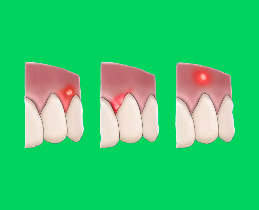 Абсцесс зуба: симптомы и лечение гноя в корне