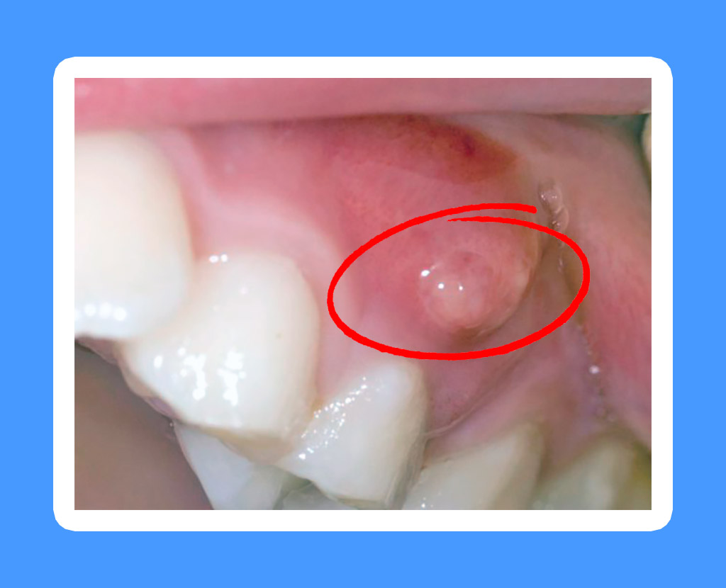Периодонтит зуба: симптомы и причины