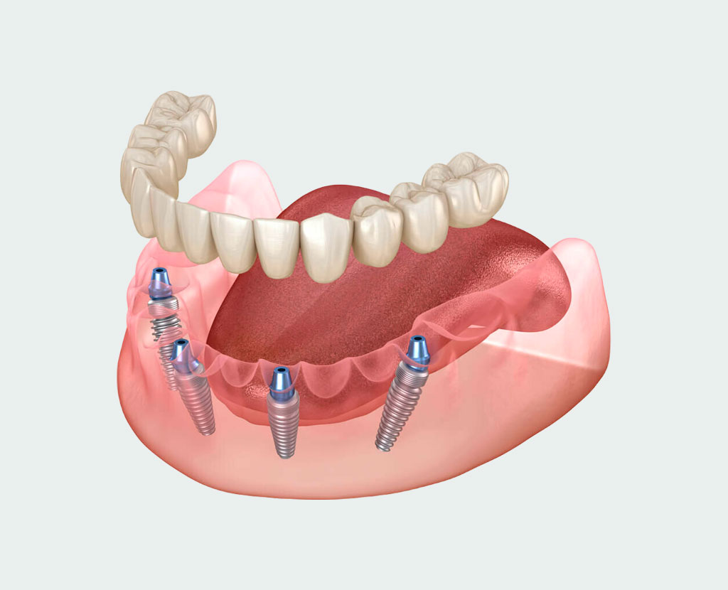 Преимущества протезирования зубов в рассрочку