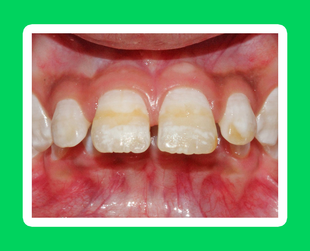 Флюороз зубов - что такое флюороз зубов: причины, методы лечения, признаки