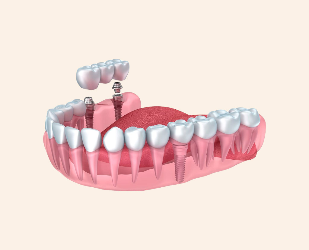 Какую имплантацию зубов выбрать: сразу после удаления или классическую?