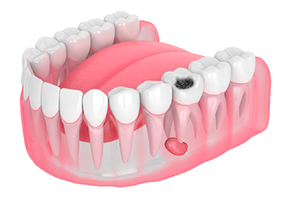 Методы наращивания зубов