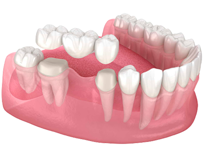 Протез при полном отсутствии зубов | Стоматология Ас-Стом | Санкт-Петербург (СПб)