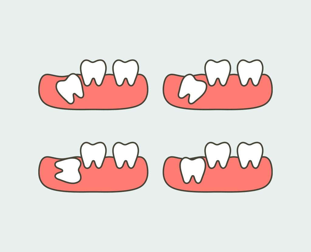 Что делать, если зубы растут вторым рядом?