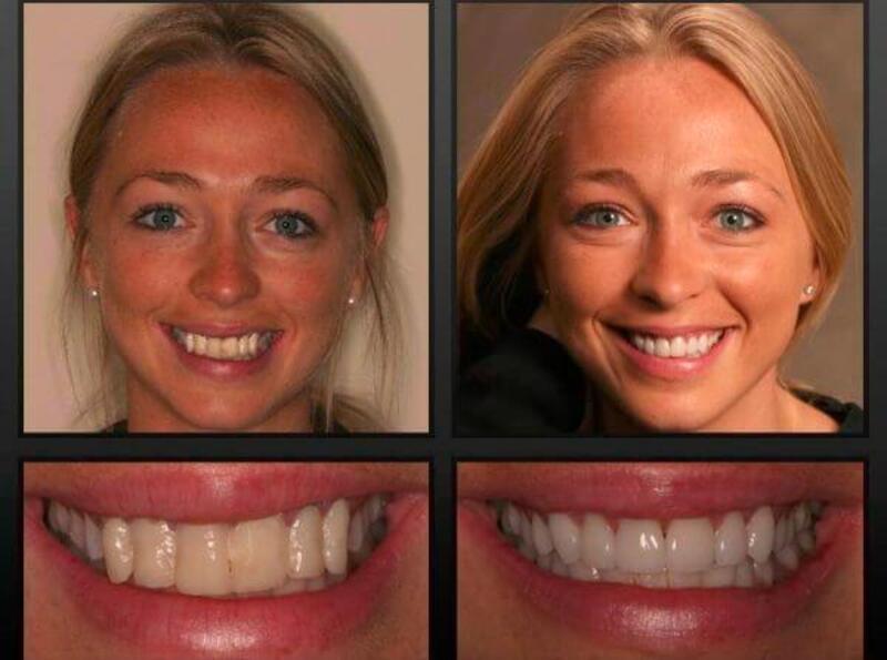 Изменение формы зубов. Керамические зубы до и после.