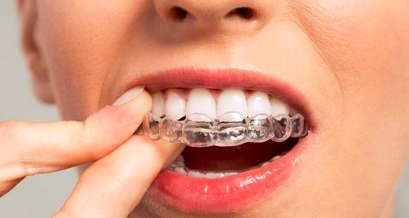 Скобки на зубы детям: эффективность, привыкание, возраст лечения