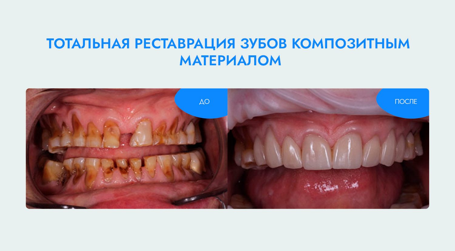 Лечение каналов зубов под микроскопом цена в Москве