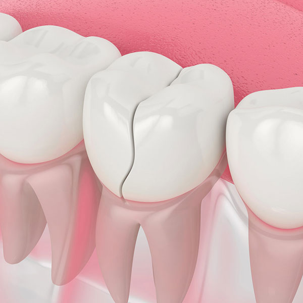 Трещины зубов: виды, причины возникновения и лечение